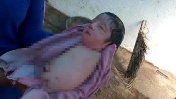 Tıp dünyası Hindistan’da doğan kız bebeği konuşuyor